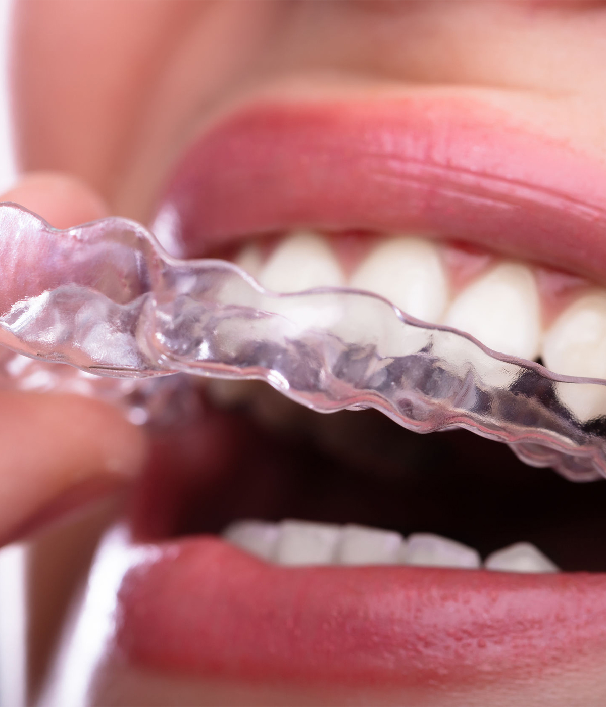 Smilers, Gouttière dentaire transparente en Algérie - Khelil's Dental Center