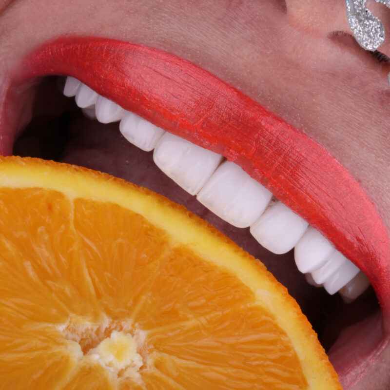 Hollywood Smile à El Mohammadia, Alger en Algérie, dentisterie esthétique visant à restaurer des dents à la fois blanches et parfaitement alignées, sourire hollywoodien.