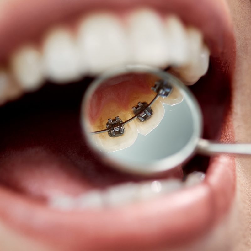 Appareil dentaire orthodontique : indication et entretien