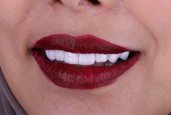 Hollywood smile en Algérie : combien ça coûte pour un patient vivant en France ?