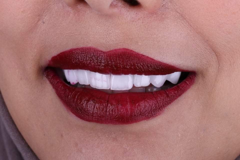 Hollywood smile en Algérie : combien ça coûte pour un patient vivant en France ?