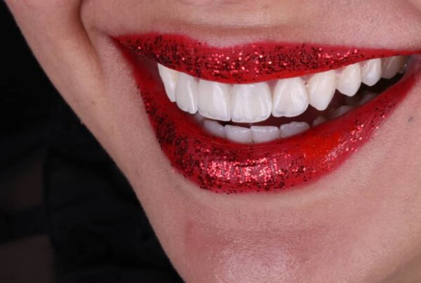 Photo après pose de facettes dentaires (hollywood smile) à Alger