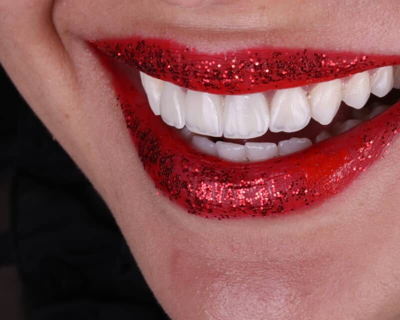 Photo après pose de facettes dentaires (hollywood smile) à Alger