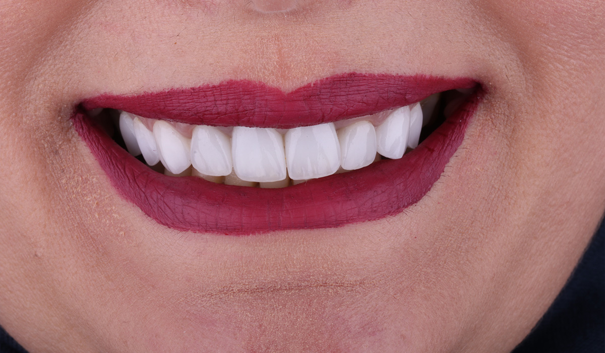 Après traitement du sourire gingival avec gingivectomie et pose de facettes dentaires à Alger