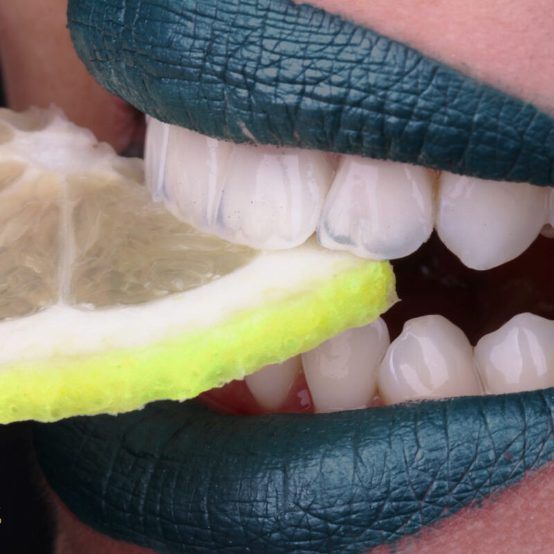 Photo après pose de facettes dentaires (hollywood smile) à Alger