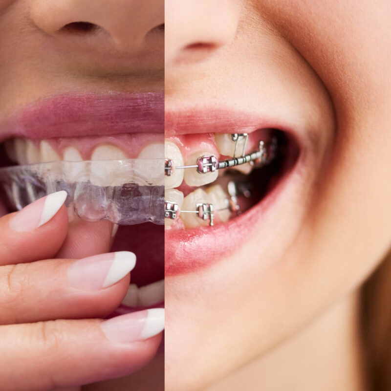 appareil dentaire odf métallique vs gouttière dentaire transparente