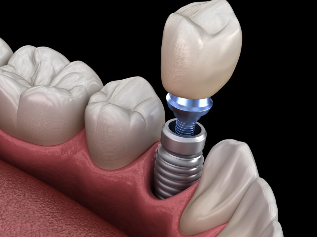 implant dentaire à Alger 
implant avec prothèse dentaire fixe (couronne dentaire) et pilier 