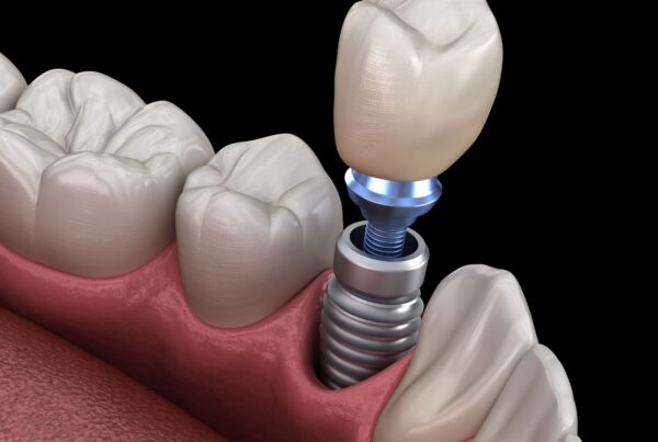 implant dentaire à Alger implant avec prothèse dentaire fixe (couronne dentaire) et pilier