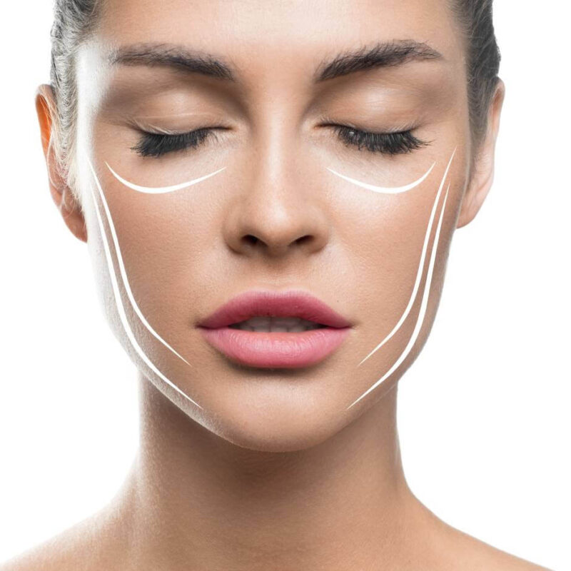 endolift à Alger, lifting sans chirurgie du visage, lifting des joues, lifting des tempes, lifting du double menton, lifting bas du visage en Algerie