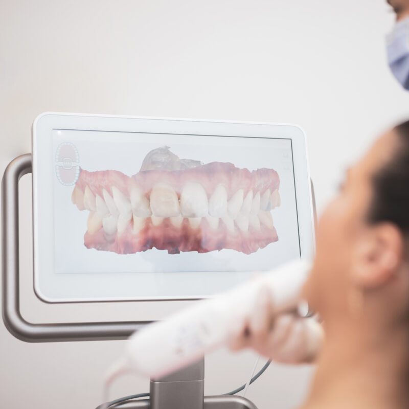 Scan intra-oral 3D d'un patient pour effectuer un traitement avec gouttière dentaire transparente à Alger en Algérie