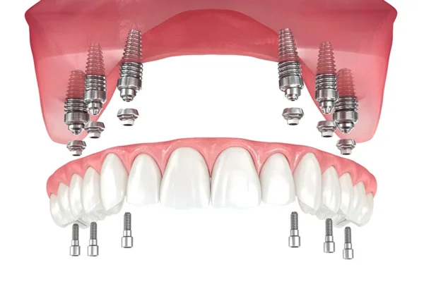 all on 6, prothèse sur 6 implants dentaires s