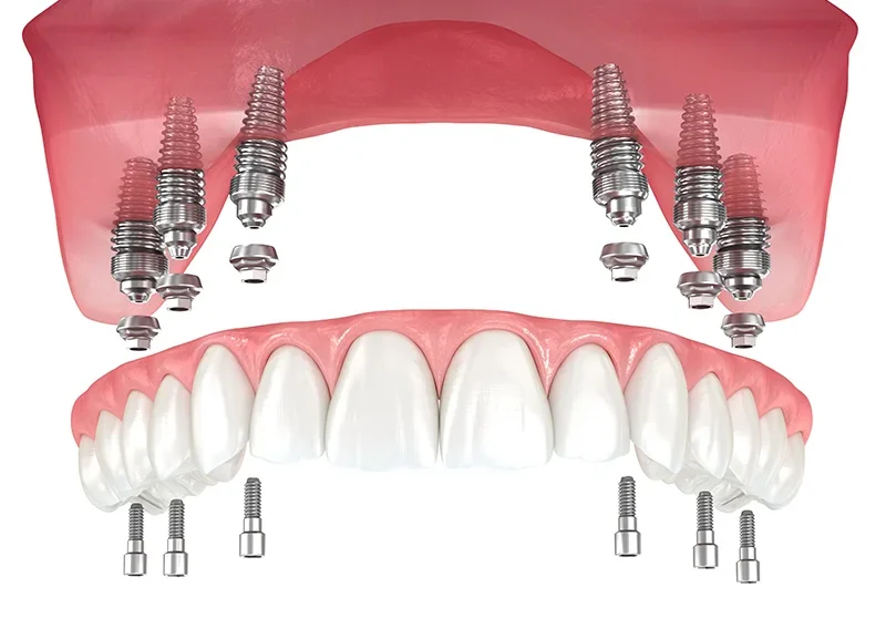 all on 6, prothèse sur 6 implants dentaires s