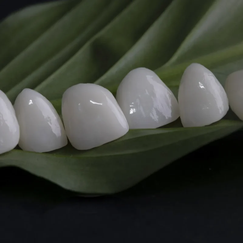 couronnes dentaires et facettes dentaires, comparaison