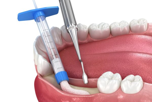 greffe osseuse avant implant dentaire à Alger en Algérie