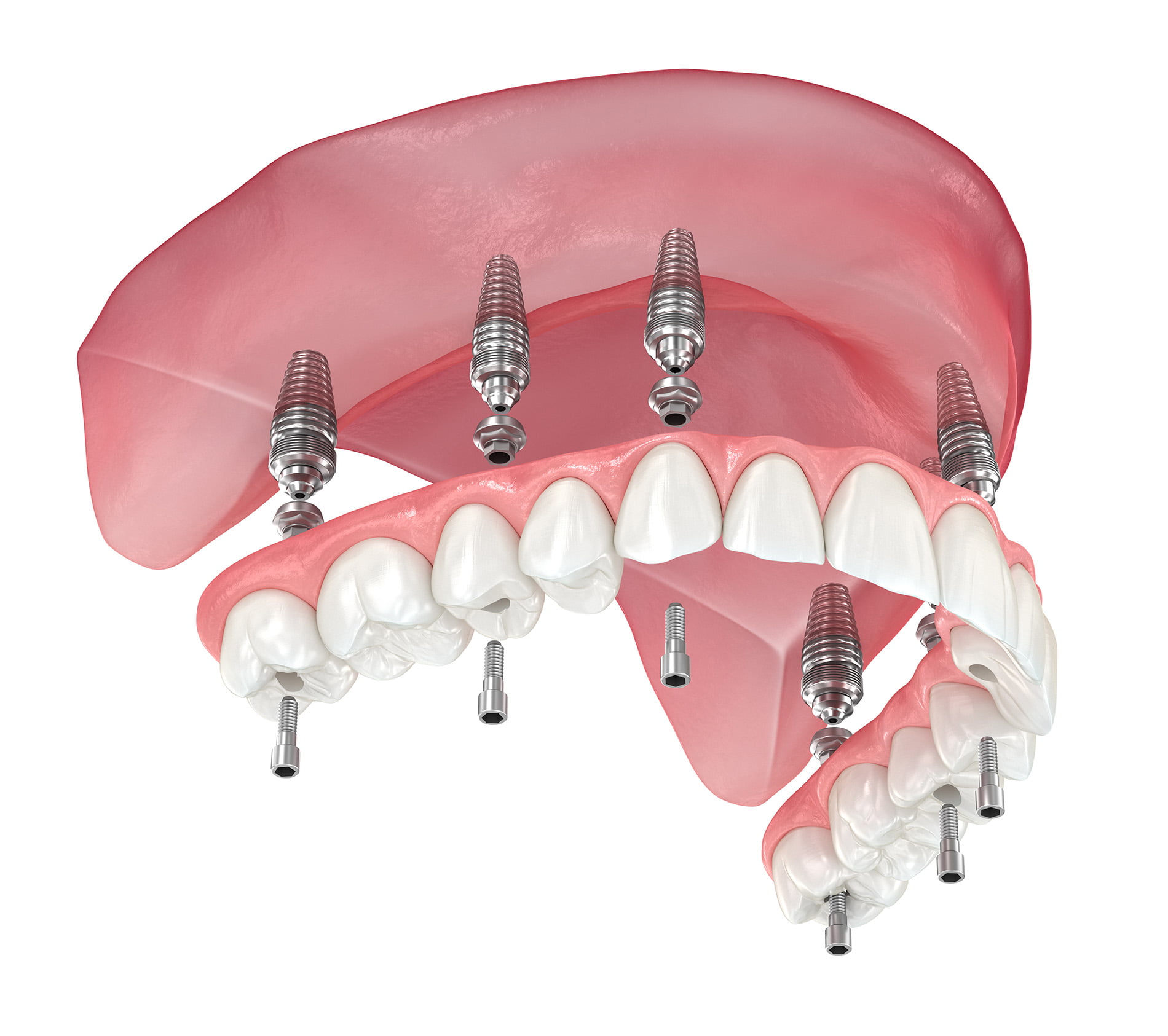 Les Dernières Innovations en Implants Dentaires : Ce Que Vous Devez Savoir