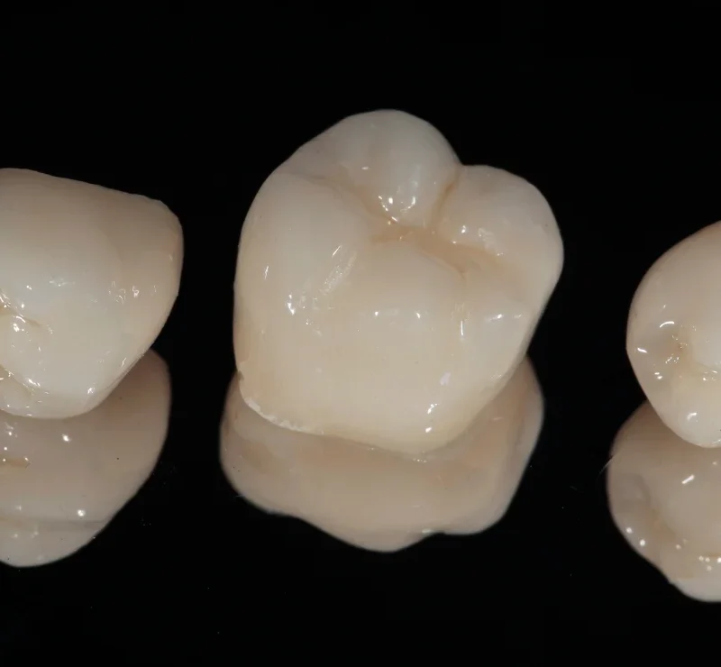 types de couronnes dentaires, zircone, céramique, céramo-metalique, céramo-céramique en Algérie à Alger
