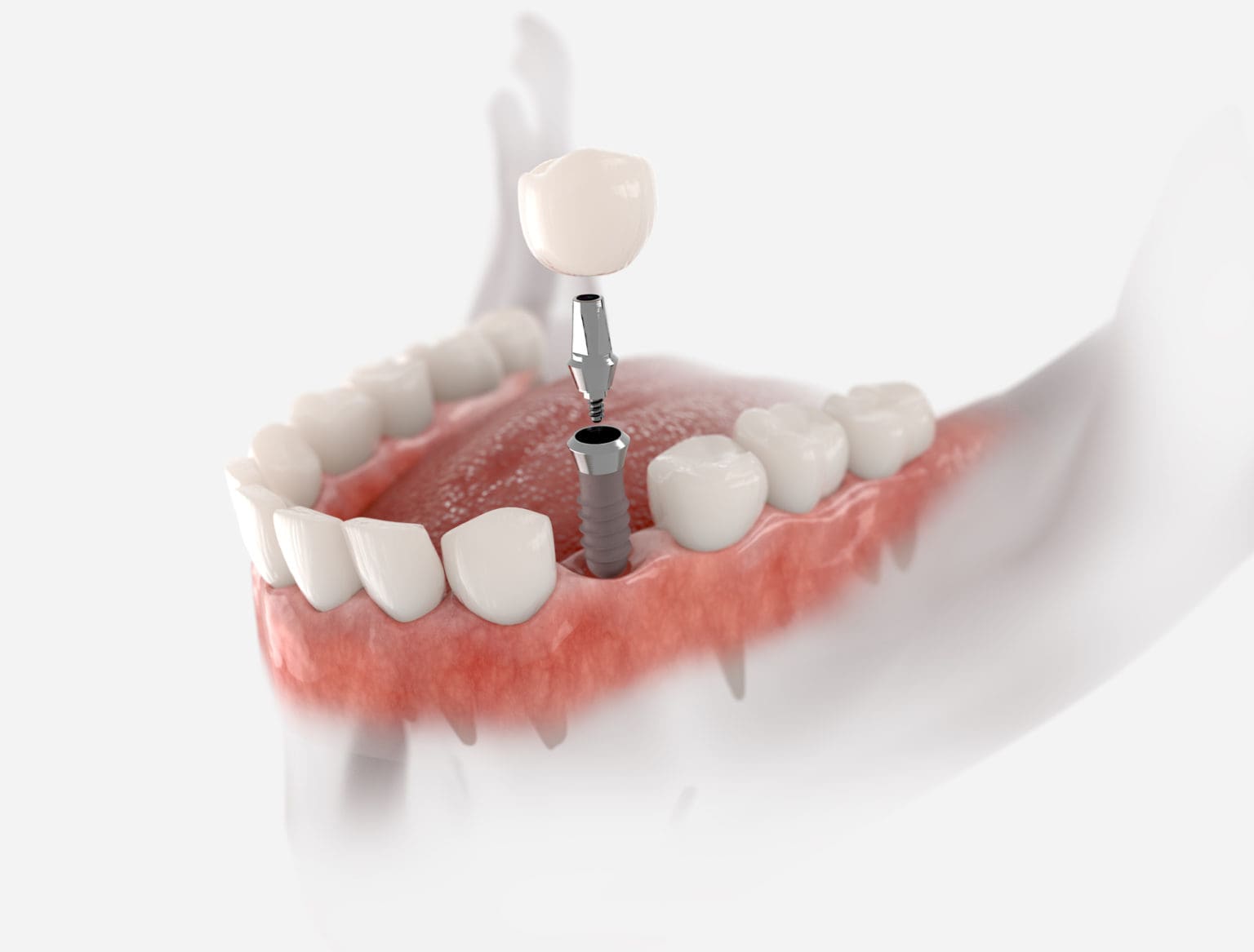 Implant dentaire en Algérie : prix, étapes et séjours depuis la France