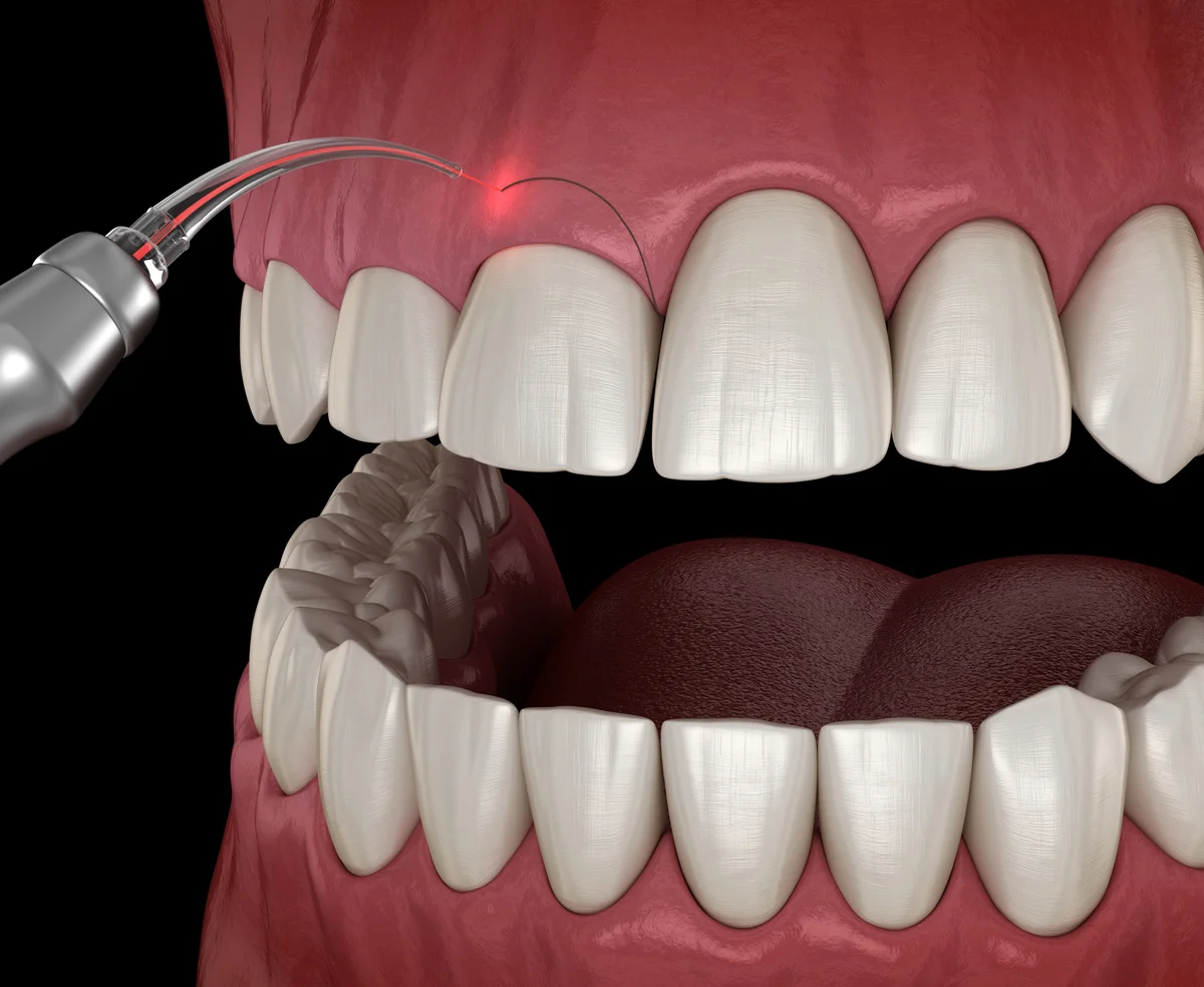 Traitement du sourire gingival à Alger en Algérie, avec chirurgie de la gingivectomie avec laser ou élongation coronaire, avec acide hyaluronique (fillers) ou avec un repositionnement des lèvres