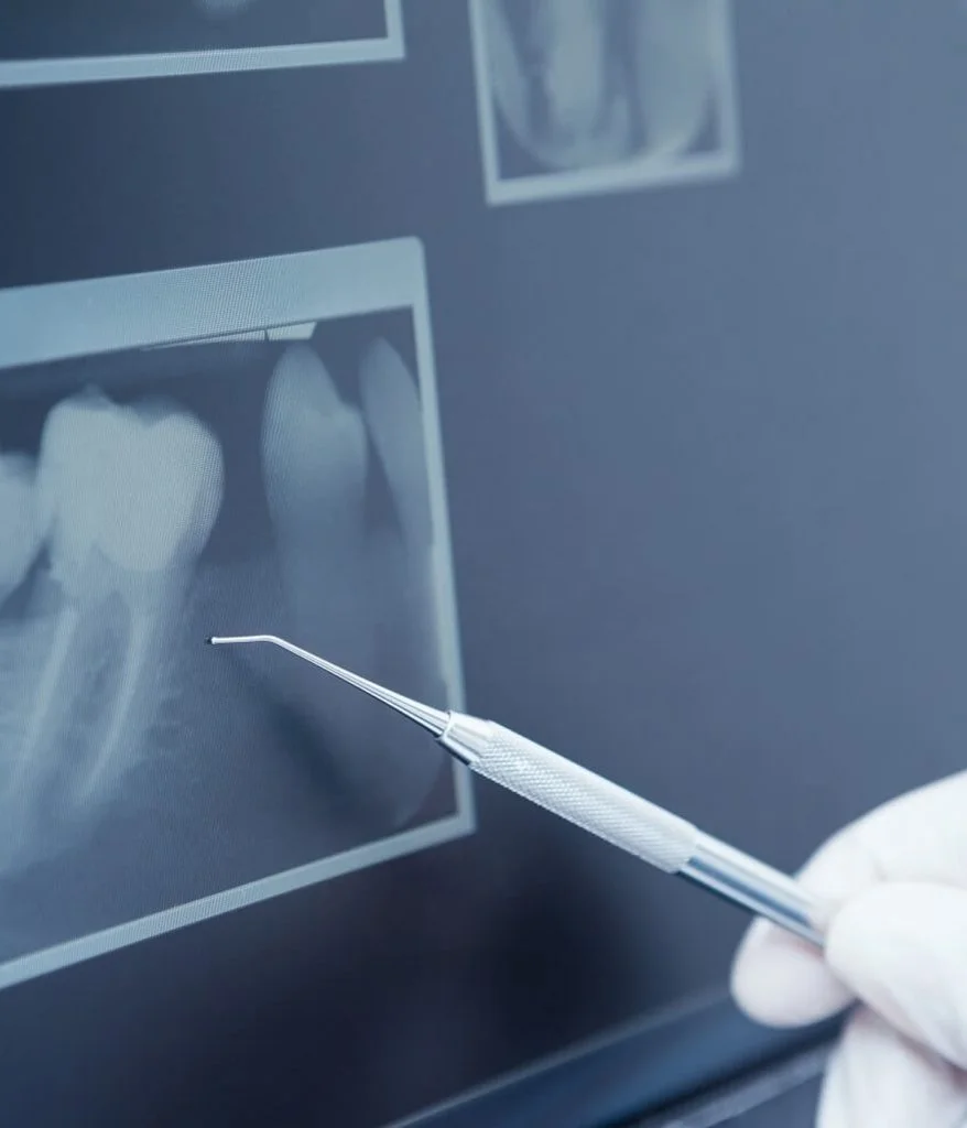 Chirurgie dentaire (chirurgie buccale) à Alger, El Mohammadia, Algérie au cabinet dentaire du chirurgien-dentiste Dr Manel Djellabi, Esthética Dental Studio
