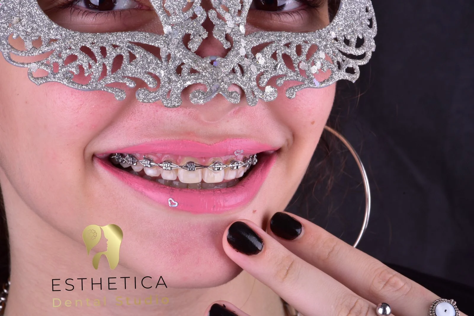 Appareil dentaire orthodontie (ODF) à Alger, appareil dentaire métallique, braquettes (brackets) dentaires